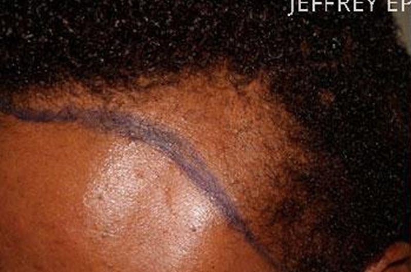 Hair Procedures for Women Before & After Gallery - Patient 369952 - Image 7
