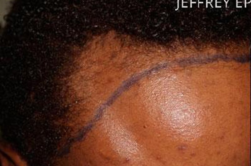Hair Procedures for Women Before & After Gallery - Patient 369952 - Image 9