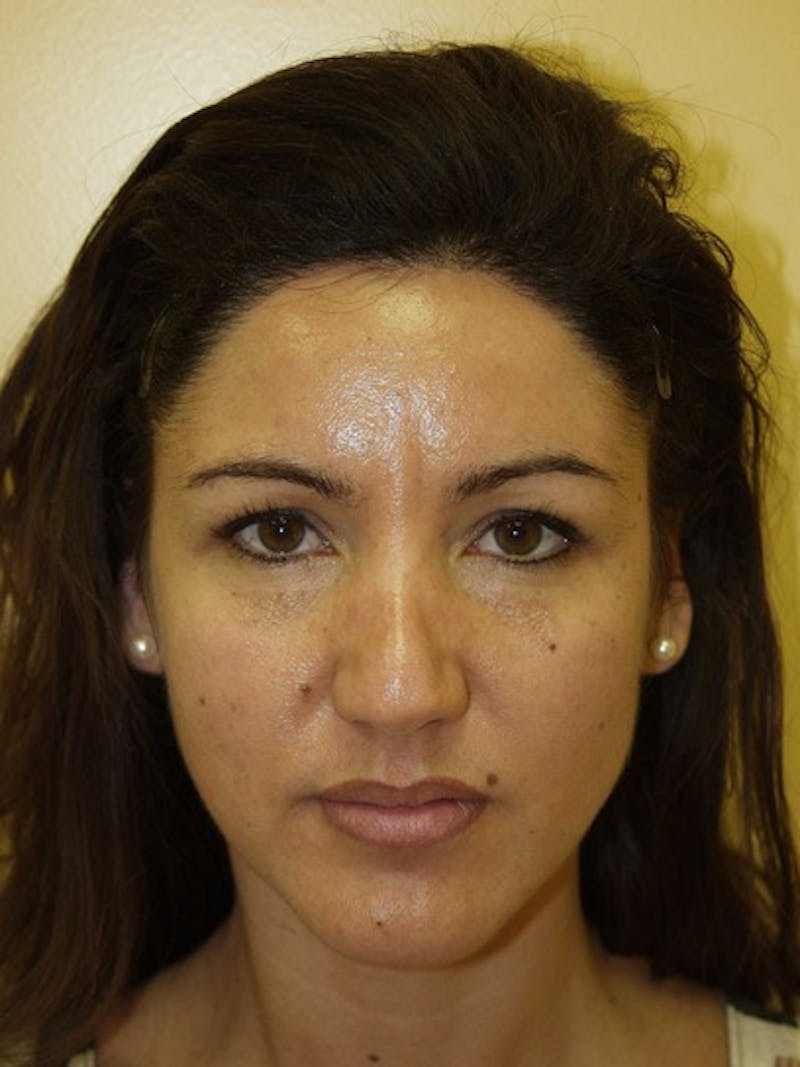 Hair Procedures for Women Before & After Gallery - Patient 102786 - Image 2