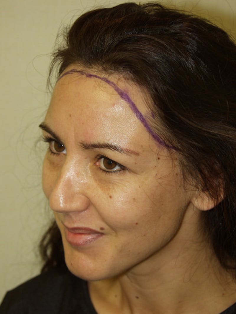 Hair Procedures for Women Before & After Gallery - Patient 102786 - Image 3
