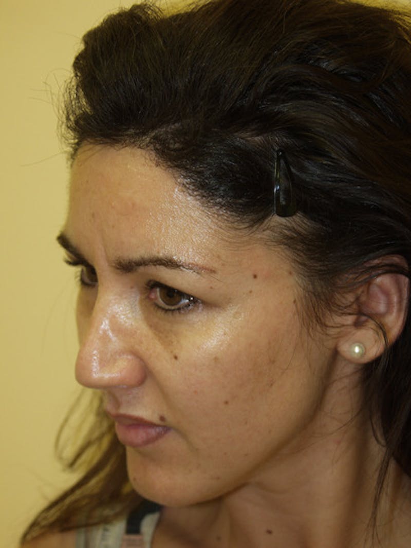 Hair Procedures for Women Before & After Gallery - Patient 102786 - Image 4