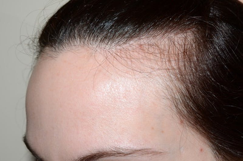 Hair Procedures for Women Before & After Gallery - Patient 346165 - Image 3