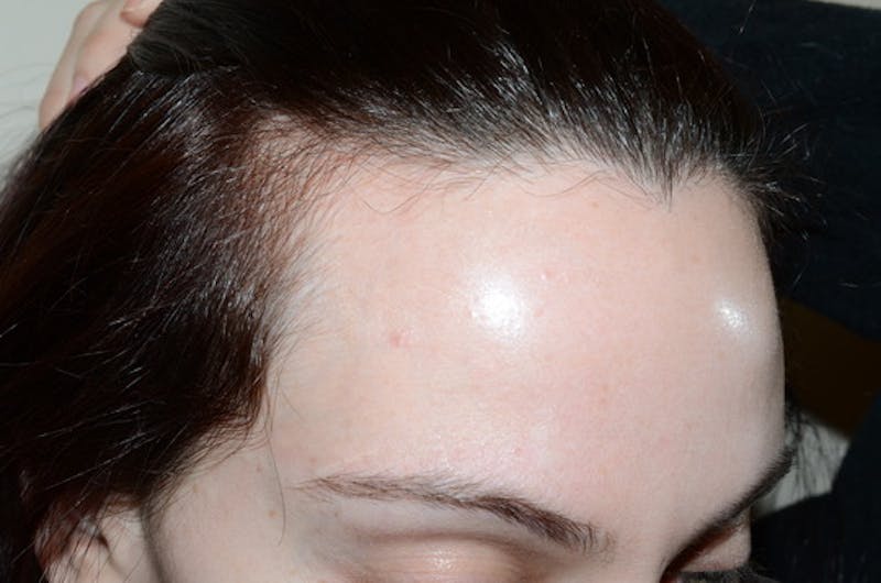 Hair Procedures for Women Before & After Gallery - Patient 346165 - Image 5