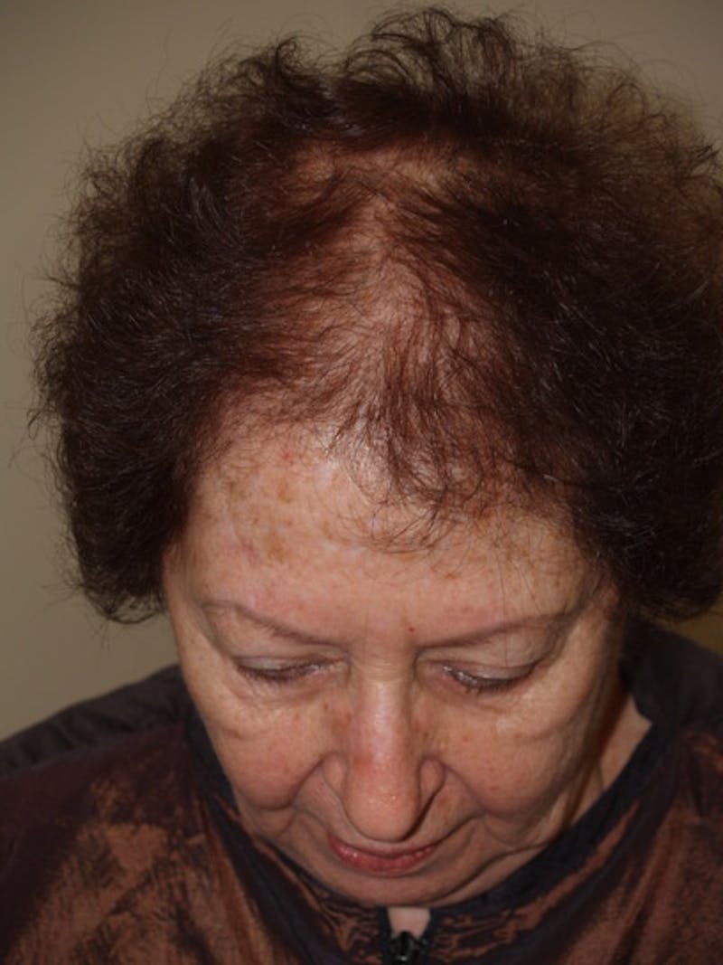 Hair Procedures for Women Before & After Gallery - Patient 333433 - Image 3