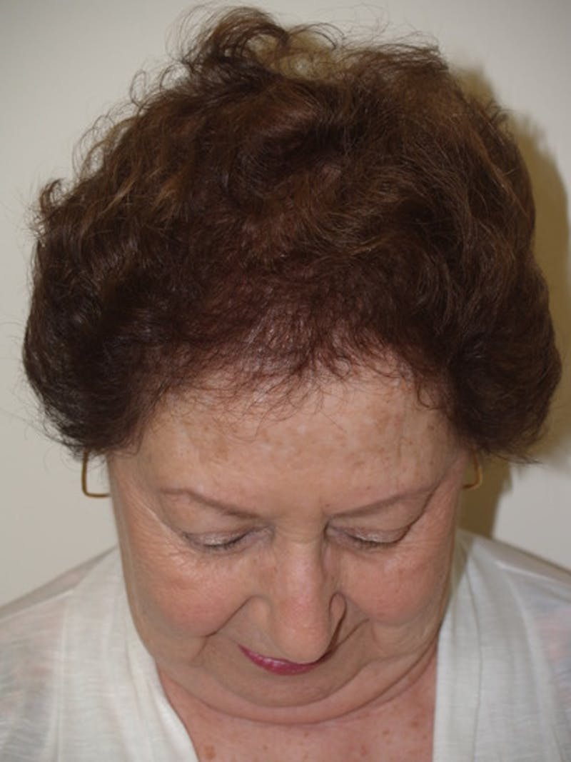 Hair Procedures for Women Before & After Gallery - Patient 199512 - Image 4