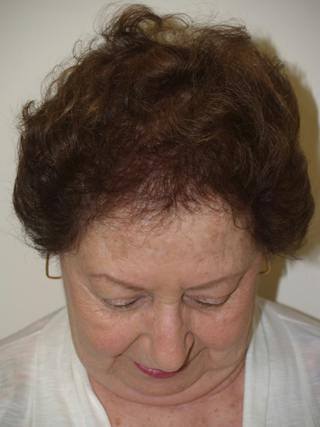Hair Procedures for Women Before & After Gallery - Patient 199512 - Image 4