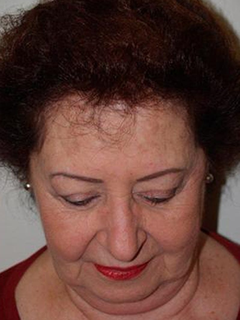 Hair Procedures for Women Before & After Gallery - Patient 333433 - Image 4