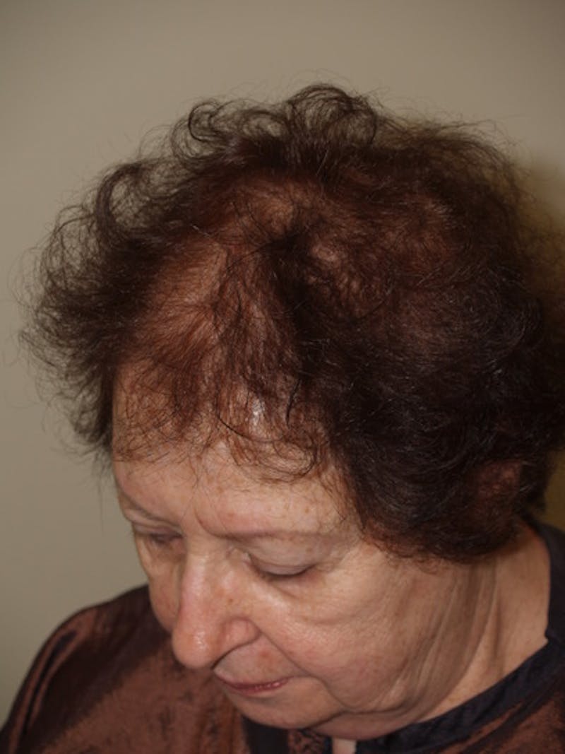 Hair Procedures for Women Before & After Gallery - Patient 333433 - Image 5