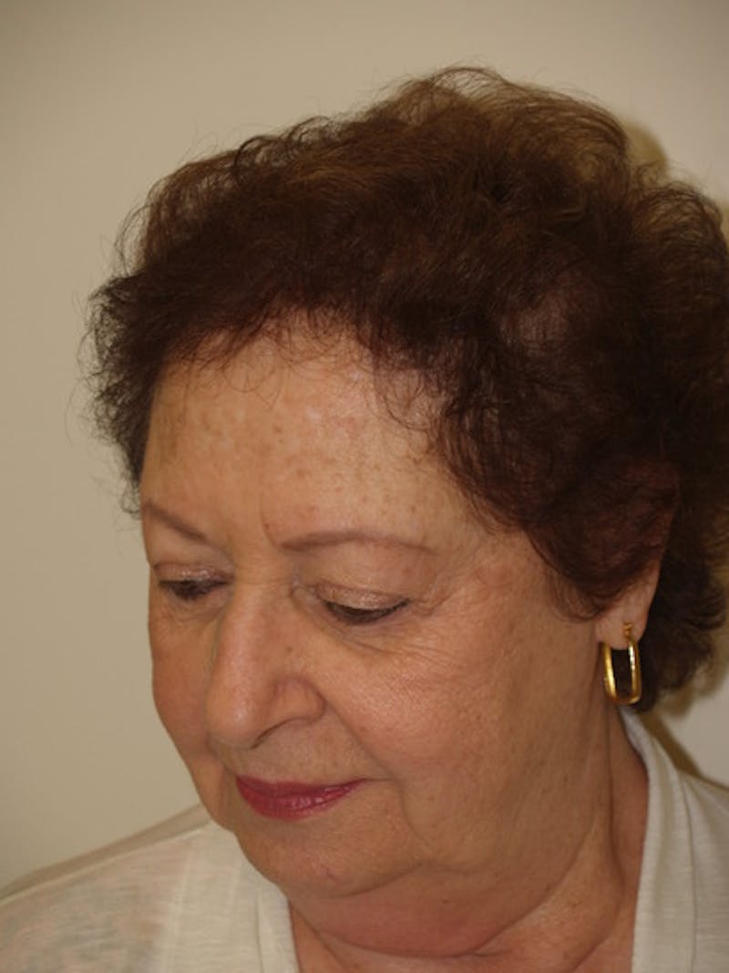 Hair Procedures for Women Before & After Gallery - Patient 333433 - Image 6