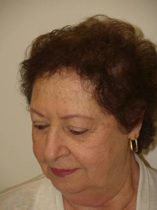 Hair Procedures for Women Before & After Gallery - Patient 333433 - Image 6