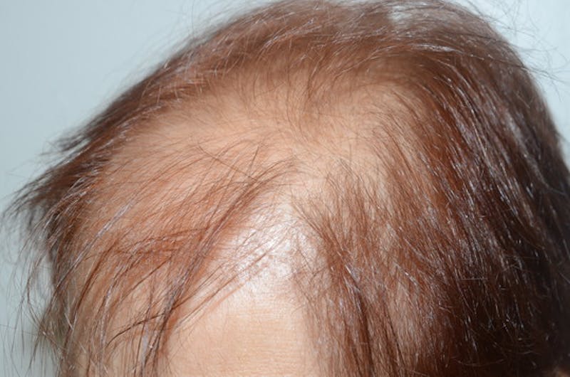 Hair Procedures for Women Before & After Gallery - Patient 387281 - Image 3