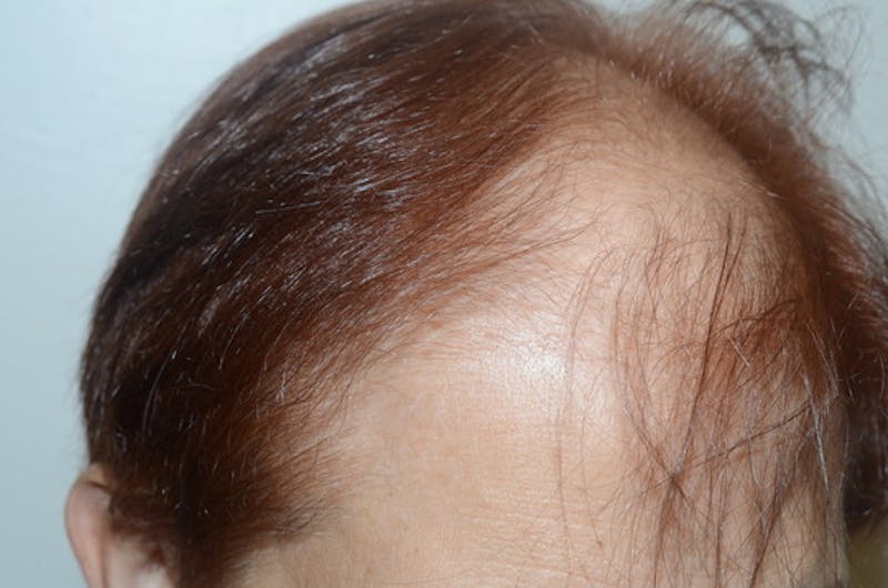 Hair Procedures for Women Before & After Gallery - Patient 387281 - Image 5