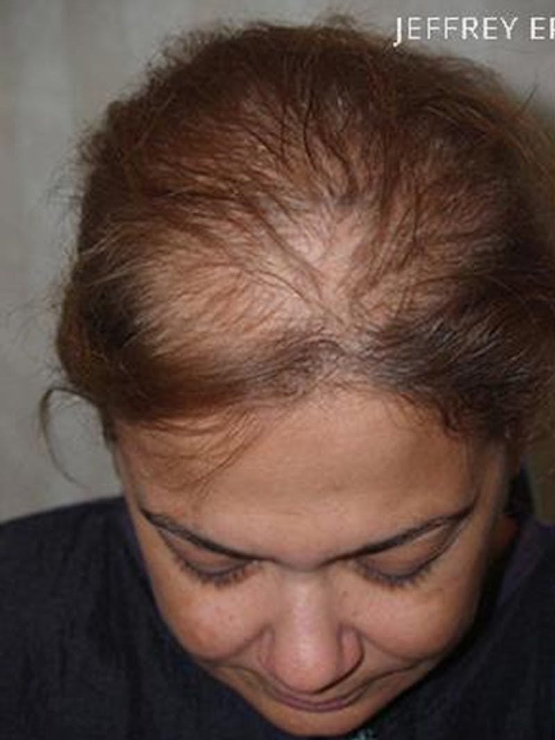 Hair Procedures for Women Before & After Gallery - Patient 108434 - Image 3