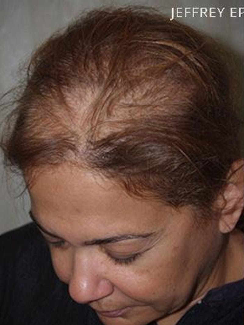 Hair Procedures for Women Before & After Gallery - Patient 108434 - Image 5
