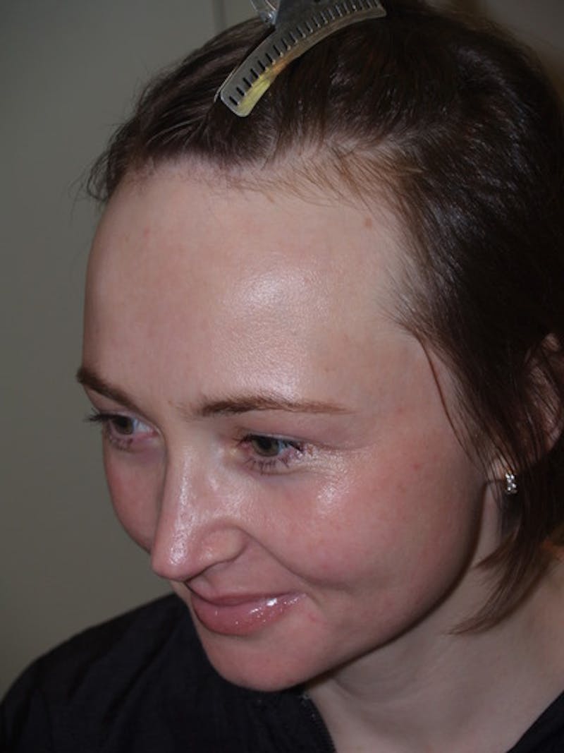 Hair Procedures for Women Before & After Gallery - Patient 327711 - Image 3