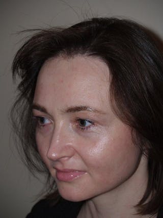 Hair Procedures for Women Before & After Gallery - Patient 327711 - Image 4