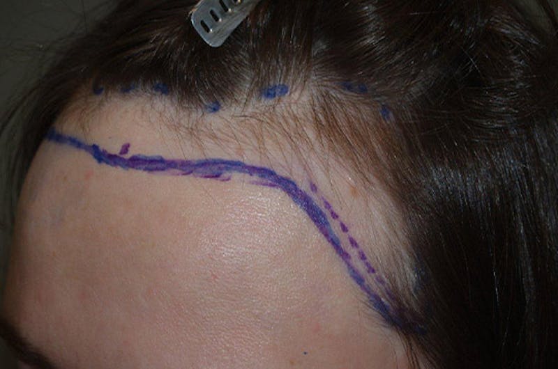 Hair Procedures for Women Before & After Gallery - Patient 327711 - Image 7