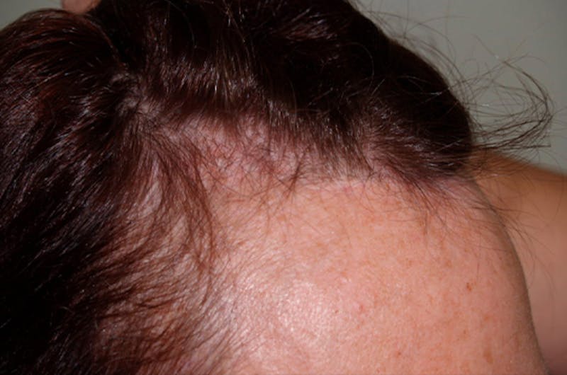 Hair Procedures for Women Before & After Gallery - Patient 111009 - Image 3