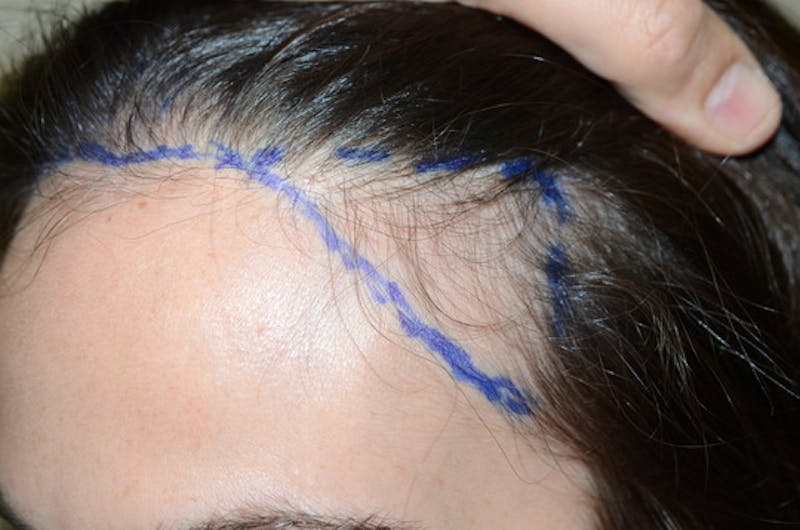 Hair Procedures for Women Before & After Gallery - Patient 494011 - Image 3
