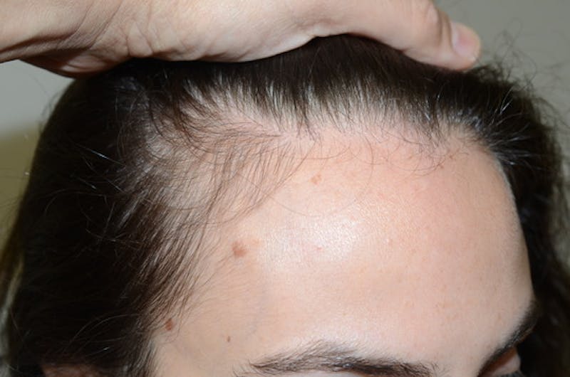 Hair Procedures for Women Before & After Gallery - Patient 494011 - Image 5