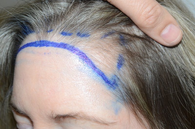Hair Procedures for Women Before & After Gallery - Patient 319595 - Image 3