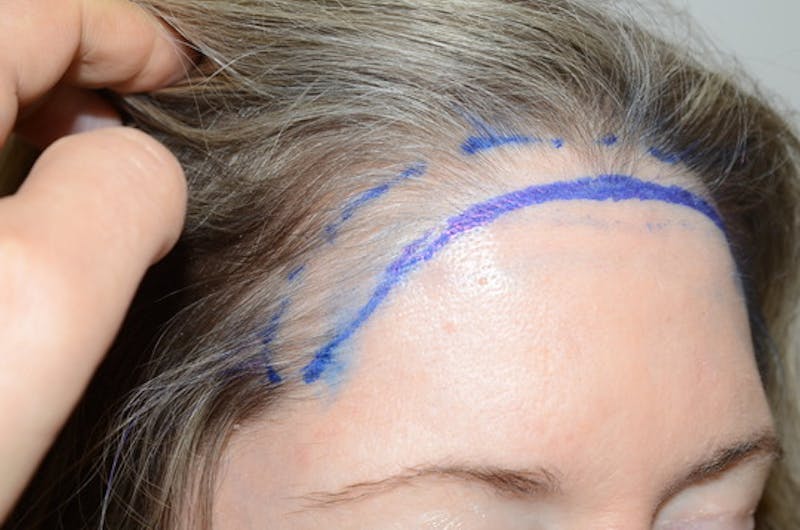 Hair Procedures for Women Before & After Gallery - Patient 319595 - Image 5