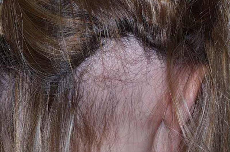 Hair Procedures for Women Before & After Gallery - Patient 127525 - Image 3
