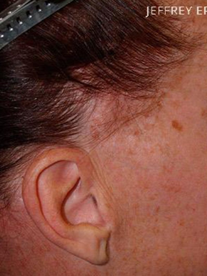 Hair Procedures for Women Before & After Gallery - Patient 104551 - Image 3