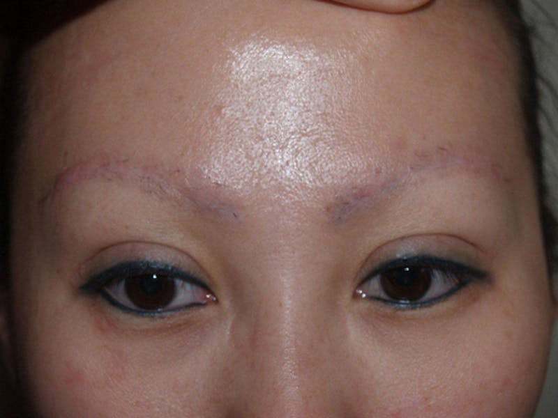 Eyebrow Transplantation Before & After Gallery - Patient 342087 - Image 3
