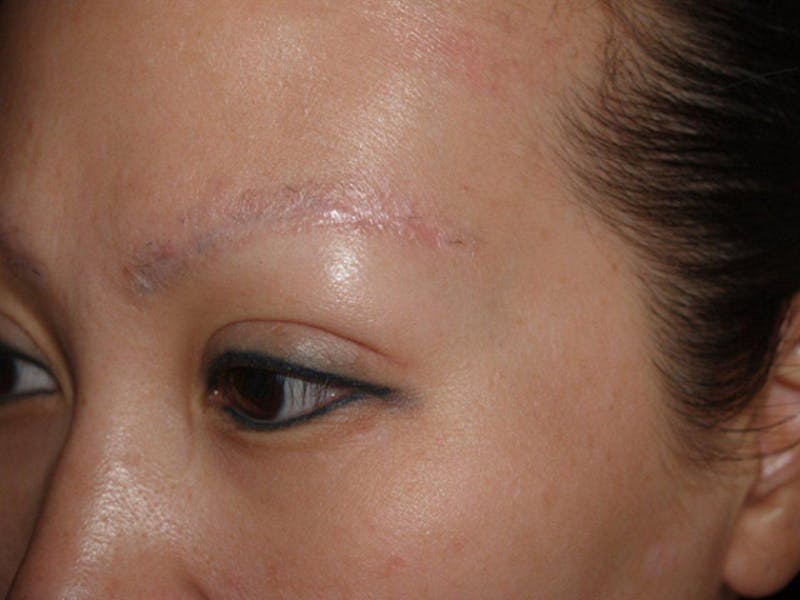 Eyebrow Transplantation Before & After Gallery - Patient 342087 - Image 5