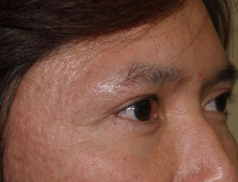 Eyebrow Transplantation Before & After Gallery - Patient 108278 - Image 3