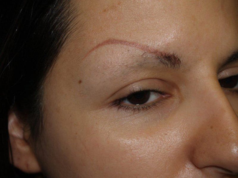 Eyebrow Transplantation Before & After Gallery - Patient 332491 - Image 3