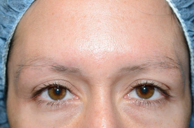 Eyebrow Transplantation Before & After Gallery - Patient 292573 - Image 3