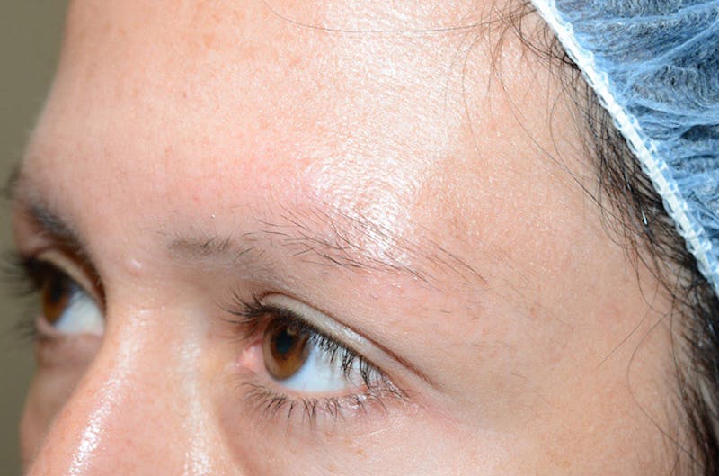 Eyebrow Transplantation Before & After Gallery - Patient 292573 - Image 5