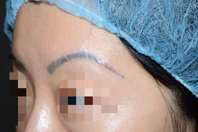 Eyebrow Transplantation Before & After Gallery - Patient 340196 - Image 3