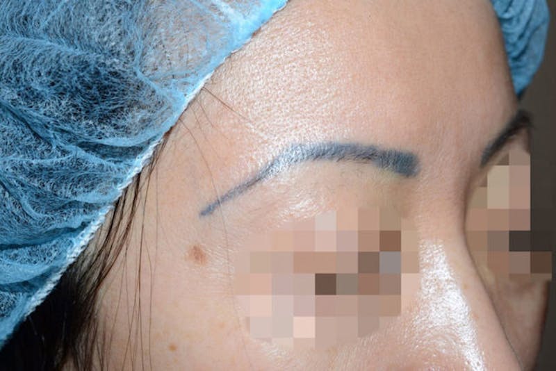 Eyebrow Transplantation Before & After Gallery - Patient 340196 - Image 5