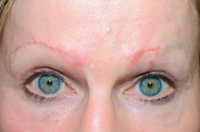 Eyebrow Transplantation Before & After Gallery - Patient 236889 - Image 1
