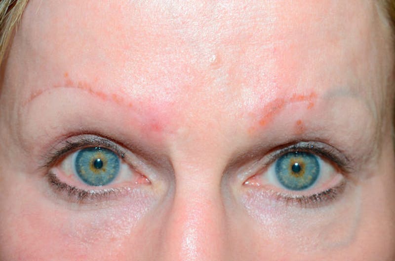 Eyebrow Transplantation Before & After Gallery - Patient 136366 - Image 1