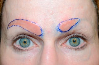 Eyebrow Transplantation Before & After Gallery - Patient 136366 - Image 2