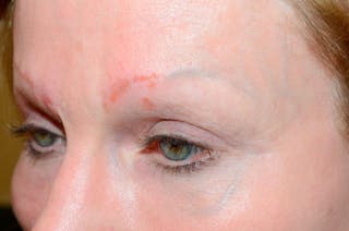 Eyebrow Transplantation Before & After Gallery - Patient 136366 - Image 4