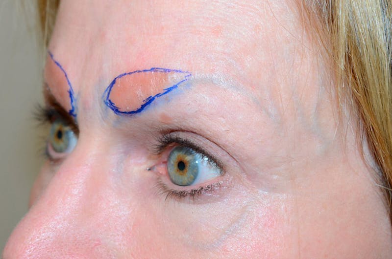Eyebrow Transplantation Before & After Gallery - Patient 509179 - Image 3