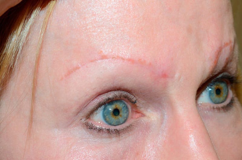 Eyebrow Transplantation Before & After Gallery - Patient 136366 - Image 7