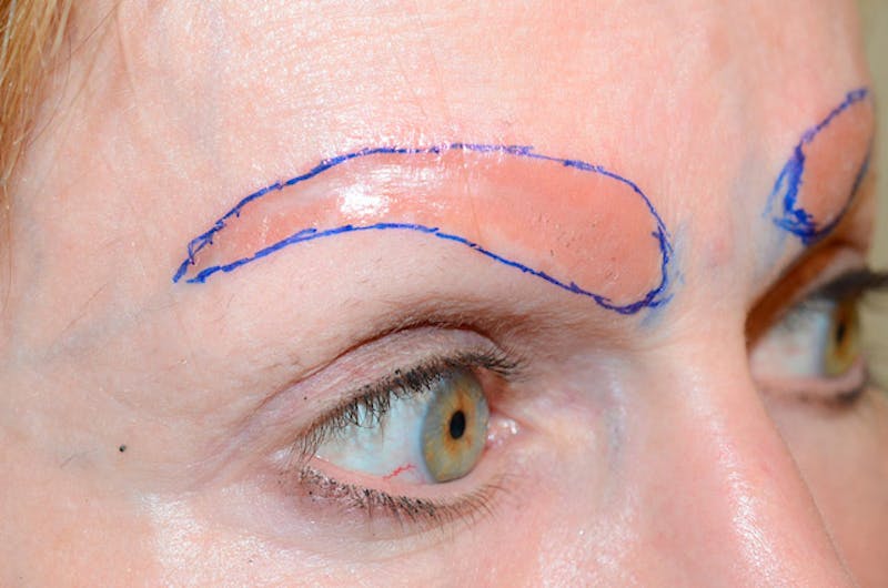 Eyebrow Transplantation Before & After Gallery - Patient 509179 - Image 5