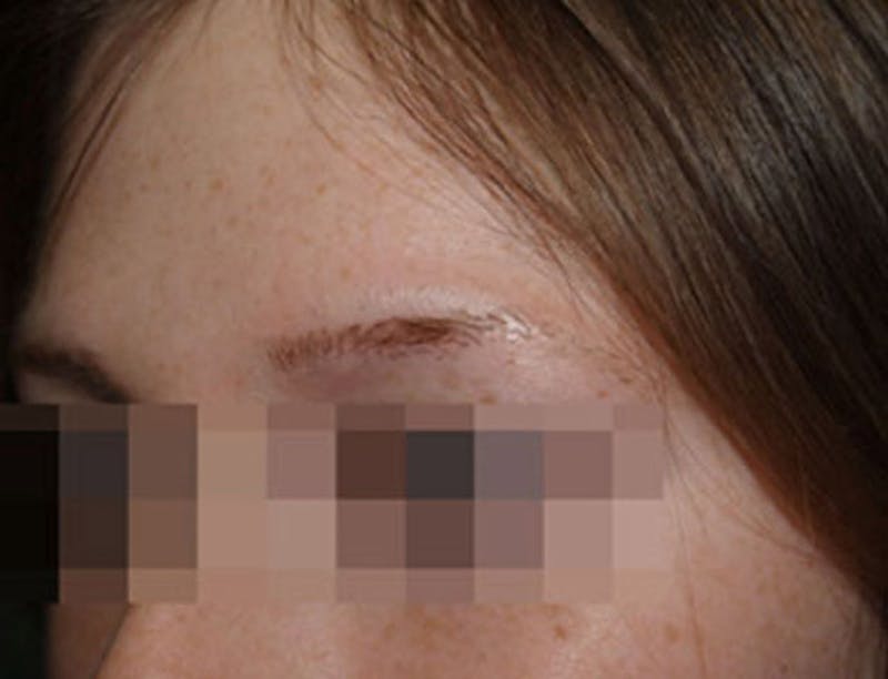 Eyebrow Transplantation Before & After Gallery - Patient 386696 - Image 3