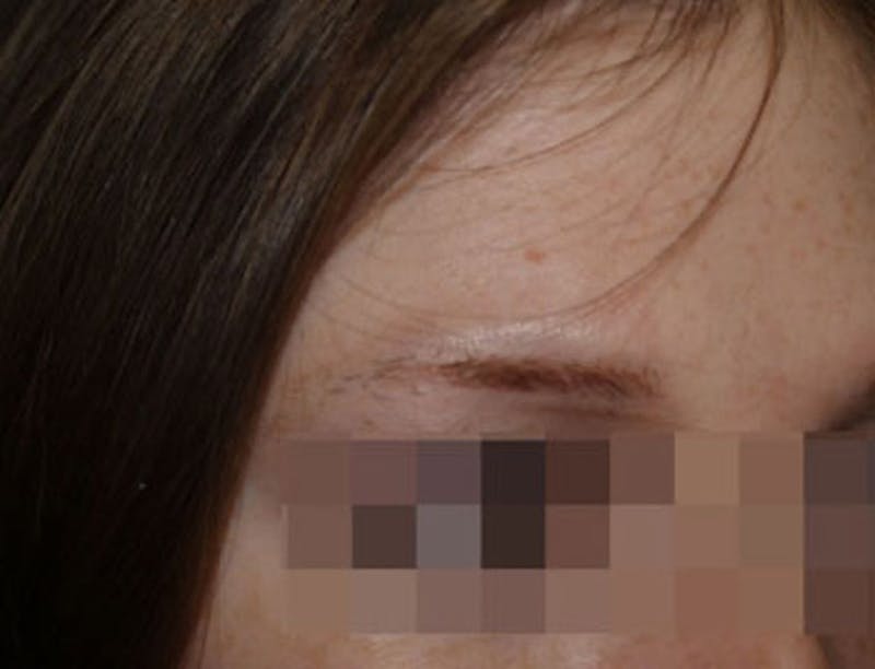 Eyebrow Transplantation Before & After Gallery - Patient 386696 - Image 5