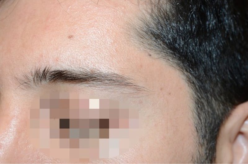 Eyebrow Transplantation Before & After Gallery - Patient 123948 - Image 3