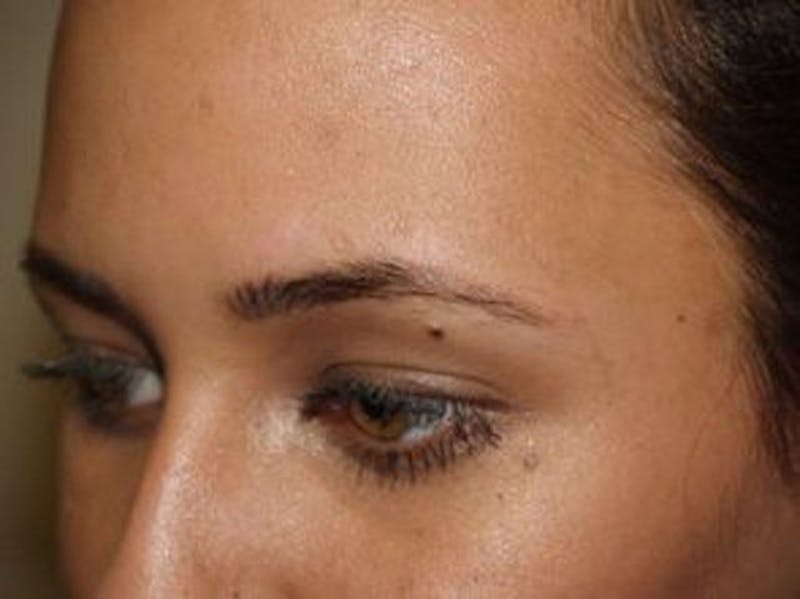 Eyebrow Transplantation Before & After Gallery - Patient 295097 - Image 3