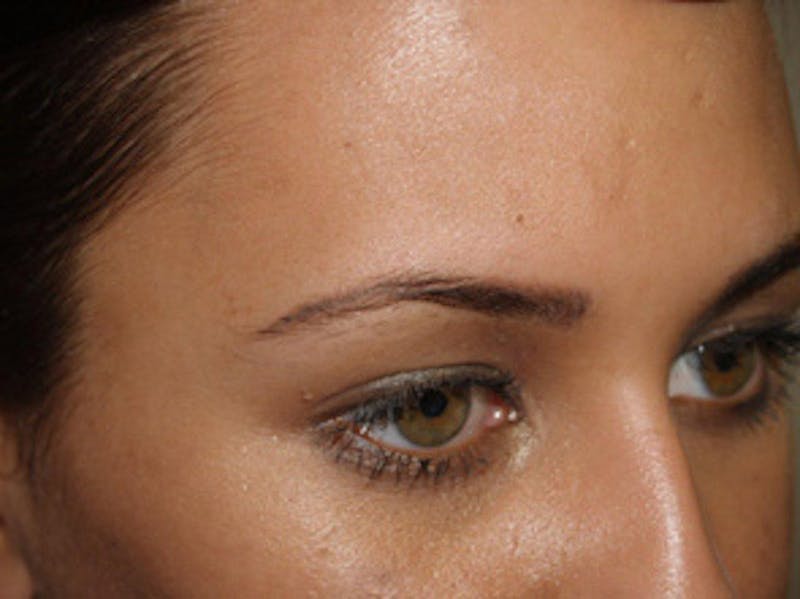 Eyebrow Transplantation Before & After Gallery - Patient 295097 - Image 5