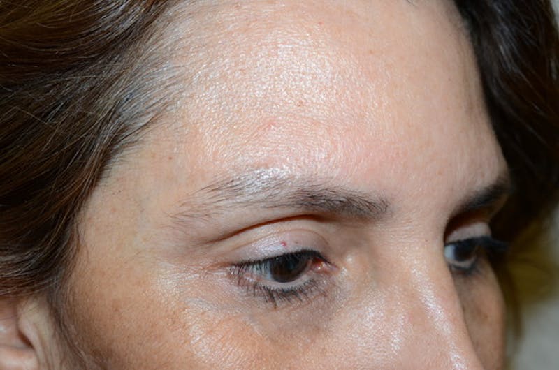Eyebrow Transplantation Before & After Gallery - Patient 334968 - Image 5