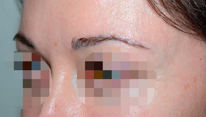 Eyebrow Transplantation Before & After Gallery - Patient 429093 - Image 3